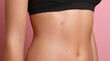 © sam richter - Closeup torso reveals irritated marks indicating dermatological sensitivity concerns.