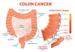 © VectorMine - Colon cancer medical illustration scheme, anatomical diagram with cancer stages and spreading to other organs, transparent background.