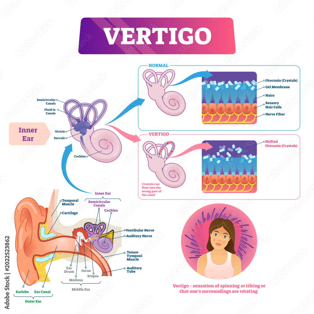 Vertigo illustration, transparent background.Labeled medical vestibular ...