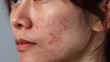 © pinkrabbit - acne on woman face with rash skin, scar, and red skin syndrome allergic to cosmetics, use steroids, dermatology, inflammation, infection, hygiene