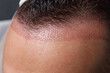 © CYS Studio - Medium shot of full hairline restoration area immediately after hair transplant surgery.