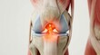 © Masque - 3D illustration of a human knee joint anatomy showing an anterior cruciate ligament ACL tear injury.