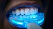 © AkinStock - Close up of human mouth using blue light led teeth whitening tray device treatment.