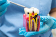 © Warawan - Dentist holding dental implant, artificial tooth roots into jaw, root canal of dental treatment, gum disease, teeth model for dentist.