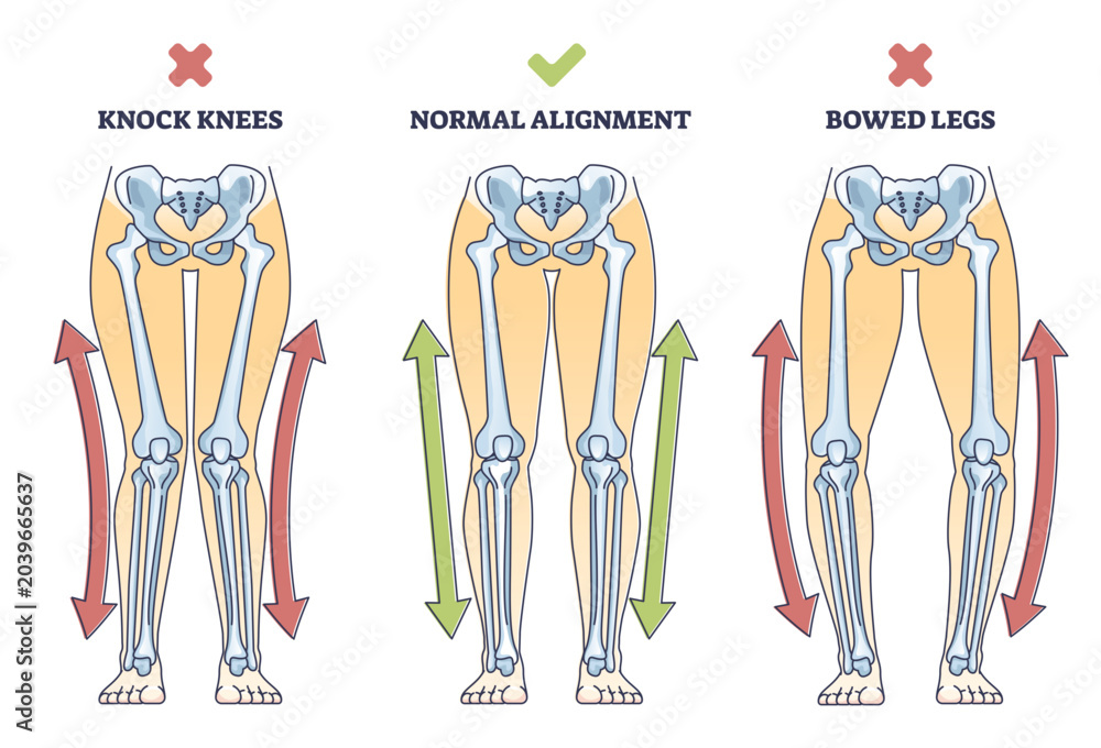 Bowed legs syndrome with normal and knock legs comparison outline ...