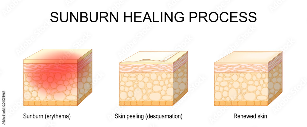 Sunburn healing process from Sunburn erythema and desquamation to