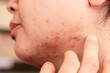 © ISENGARD - Close up of woman cheek with problematic skin conditions including acne, pimples, red spots and blemishes. Healthcare, dermatology skincare treatment concept with copy space backdrop