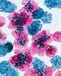 © Justlight - Medium shot of ovarian cancer cells under high magnification highlighting irregular blue nuclei and clustered malignant morphology with pink cytoplasm on a crisp white microscope