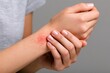 © Ajay - Woman gently touches red patch on her wrist. Skin appears irritated