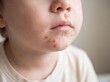 © Giama22 - A professional photography close-up shot of a child's face around the mouth and nose showing Impetigo, characterized by highly contagious, honey-colored crusts over shallow, red sores, soft neutral li