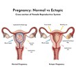 © Fatema Khanam Chy - Comparison illustration of normal and ectopic pregnancy illustrating female reproductive system crosssections with key anatomical features highlighted
