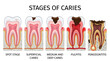 © Naima - Infographic illustration showing stages of tooth decay, from spot to periodontitis.