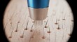 © White Craft  - Close-up of skin treatment with blue device targeting pores