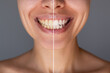 © Марина Демешко - Before and after close up of woman's smile showing yellow and white teeth comparison. Dental whitening, oral care and cosmetic dentistry concept