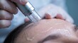 © Sugar Love Love - Microneedling pen treatment on forehead with clear serum