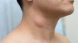 © Pediatric Visuals - Closeup of a man with a swollen lymph node on the side of his neck, indicating potential infection or inflammation