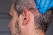 © Anat art - Male patient with psoriasis on scalp is examined by a healthcare professional wearing gloves, showcasing skin condition in a clinical environment