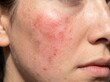 © mimiow - Rosacea erythema flare up showing flushed red cheek on face