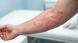 © Olga Ко - Nahaufnahme eines Arms mit starkem allergischen Hautausschlag, Rötungen und juckendem Ekzem. Medizinischer Hintergrund in einer Klinik, Konzept für Dermatologie, Hautkrankheiten und Allergiebehandlun.
