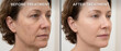 © Watercolor_Concept - Facelift transformation article with clear before-and-after images.