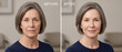 © Watercolor_Concept - A young woman, Facelift transformation article with clear before-and-after images, focusing on long-term improvements in facial wrinkles.