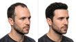 © Rama A - Before and after hair loss treatment result showing man with thinning and full hair