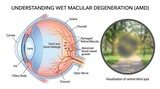 Anatomical diagram of wet macular degeneration eye condition with vision loss