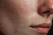© Kucraft Creator - Moderate Acne Breakout on Facial Skin with Inflammation