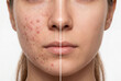 © Francesco  - Woman comparing acne skin improvements on a split face