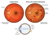 Healthy retina vs diabetic retinopathy comparison illustration isolated on white background