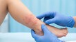 © Olga Ко - Pediatrician doctor in blue gloves examining a severe red allergic rash and eczema on a child's leg. Skin disease and pediatric healthcare concept