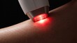 © qian - Macro shot of IPL laser hair removal device emitting red light flash on human skin