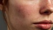 © Kucraft Creator - Mild Allergic Reaction and Redness on Cheek