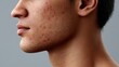 © Dmitriy - Close-up of a young man's side profile with visible inflammatory acne on his jaw and neck against a gray background; ideal for dermatology and skincare concepts.