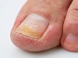 © Mi - Close‑up of toenail fungal infection, onychomycosis symptom, yellow thickened damaged nail, foot skin disease, medical clinical material on white background