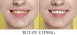 © New Africa - Teeth whitening, collage. Smiling woman before and after procedure, closeup