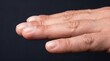 © Faye Visuals - Close up of human fingers demonstrating mild clubbing nail deformation