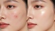 © DELstudio - Split screen comparison of acne prone skin and clear glowing complexion showing skincare treatment results dermatology beauty routine before and after facial improvement concept