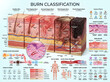 © Harsh - Burn classification chart displaying anatomical skin layers along with injury mechanisms and medical healing processes for educational biological health research