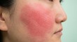 © qian - Malar rash butterfly erythema on female face cheek lupus sign