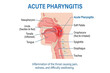 © abdul - Medical illustration of the human throat showing acute pharyngitis inflammation and anatomical structures of the upper respiratory tract