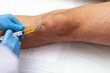 © Alla - Intraarticular injection of platelet-rich plasma (PRP therapy) into patient's knee for joint treatment in an orthopedic clinic. Plasma therapy procedure in orthopedic clinicown biomaterial