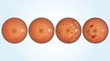 Four-stage diabetic retinopathy progression from healthy retina to advanced vascular damage shown in premium clinical CGI on a clean pale blue medical background with copy space.