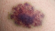 © josehp - Fotografía médica macro de alta resolución, primer plano íntimo centrado puramente en un hematoma y contusión subcutánea significativa sobre piel humana
