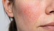 © AZIM - Close up view of female face showing skin redness and rosacea symptoms on cheek