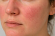 © Natthasit - Close up of woman face with facial redness caused by rosacea skin condition