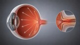 3D Medical Illustration of Human Eye Anatomy Showing Optic Nerve Detail and Intraocular Pressure Glaucoma Diagram