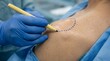 © AkinStock - Surgeon marking dotted line outline on patient skin prior to procedure