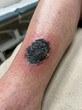 © Imarn - Close up of a necrotic skin lesion with eschar on a human lower leg in a clinical setting