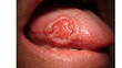 © Nolas - Tongue lesion with a raised ulcerated surface and inflamed red center is shown in a medical close-up.